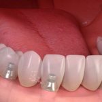 riesgos-complicaciones-implantes-dentales