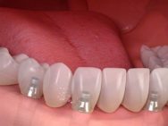 Los riesgos y las posibles complicaciones de los implantes dentales